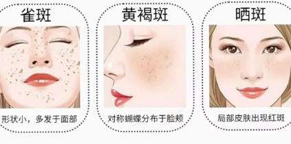 祛斑