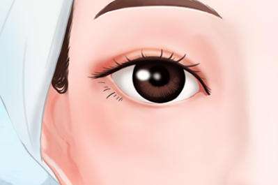 双眼皮 双眼皮