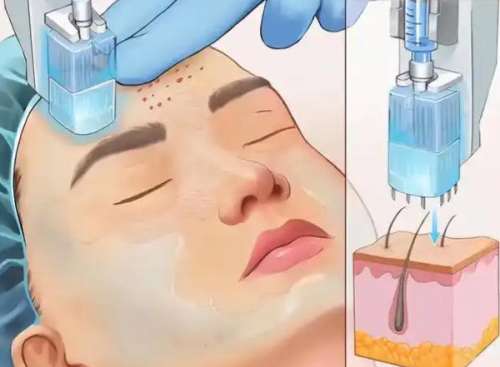 黄金微针 黄金微针