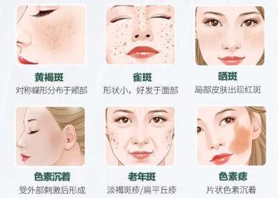 祛斑