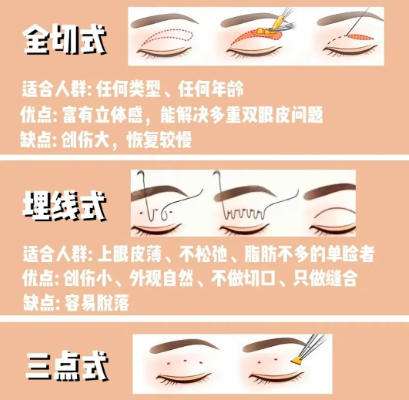 浙一医院割双眼皮多少钱？2026价格表更新！技术优势剖析