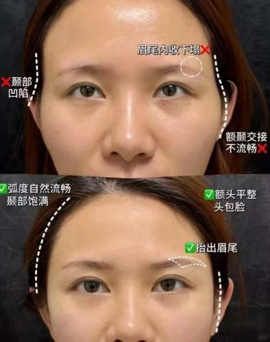 #太阳穴填充 微调一下就很美_1_回魂丹 丹_来自小红书网页版 (1).jpg